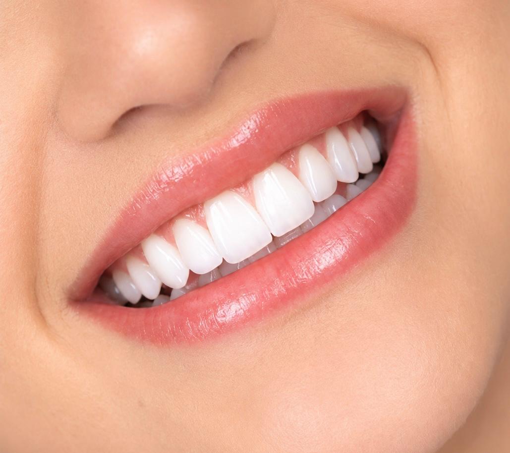 Diseño de sonrisa