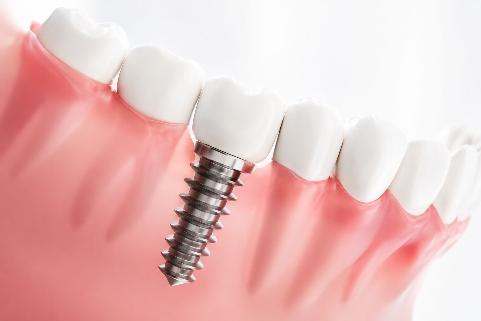 Implantes dentales